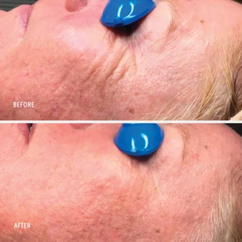 collagen reactivate pm before after 2 - Зволожувальний ліфтинг-крем з ретинолом Hydropeptide Collagen ReActivate PM 30мл