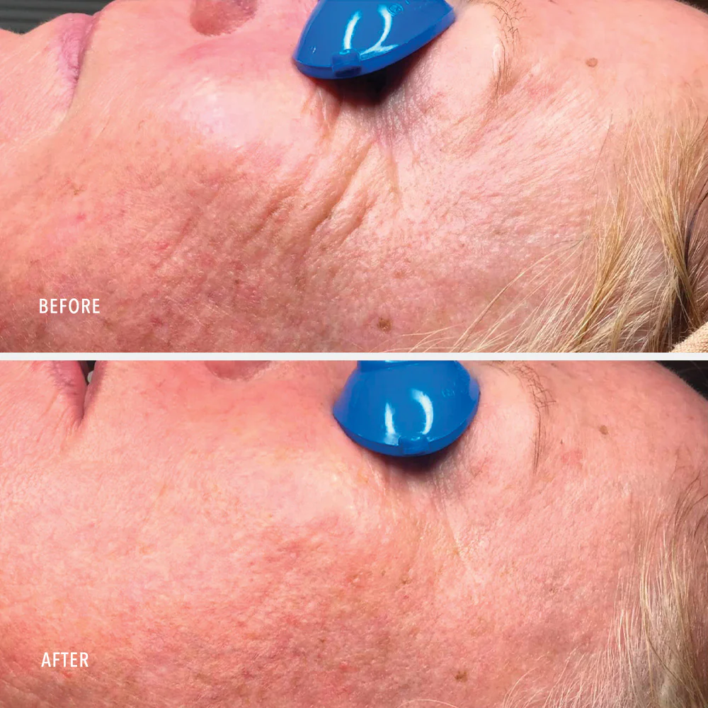 collagen reactivate pm before after 2 - Зволожувальний ліфтинг-крем з ретинолом Hydropeptide Collagen ReActivate PM 30мл