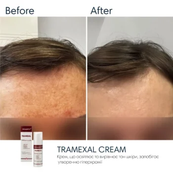 2 - Освітлюючий крем проти пігментації Braderm Tramexal Cream 30мл