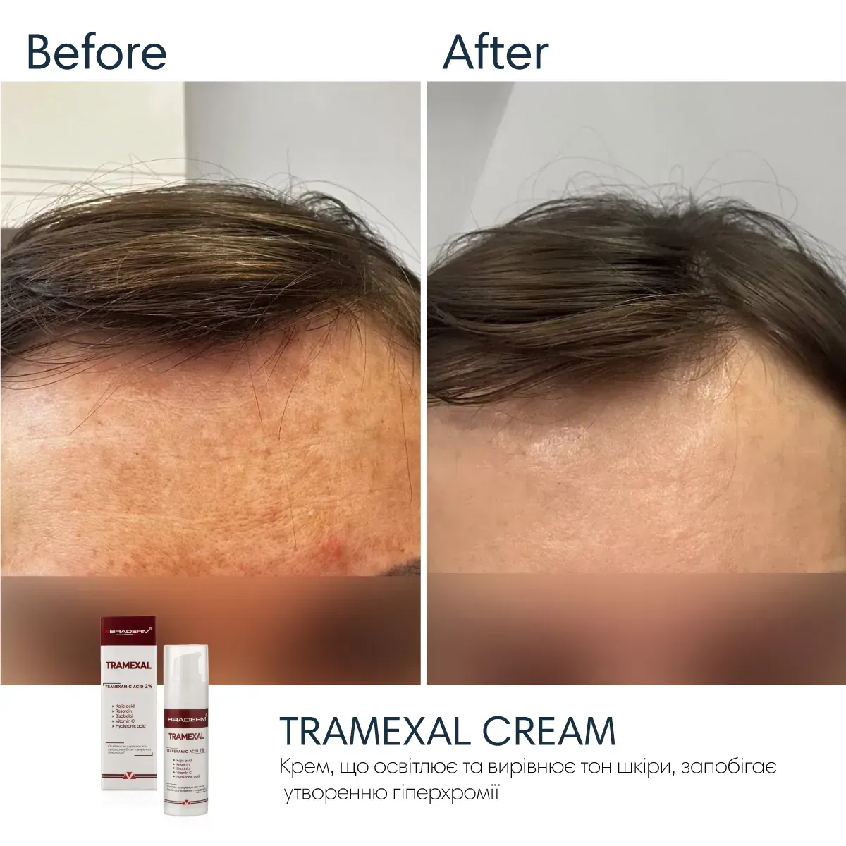 2 - Освітлюючий крем проти пігментації Braderm Tramexal Cream 30мл