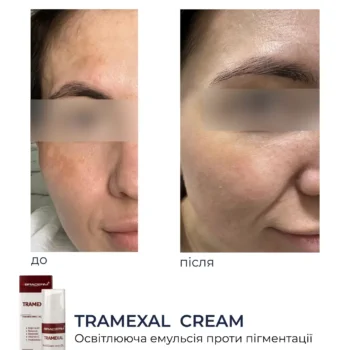 22 - Освітлюючий крем проти пігментації Braderm Tramexal Cream 30мл