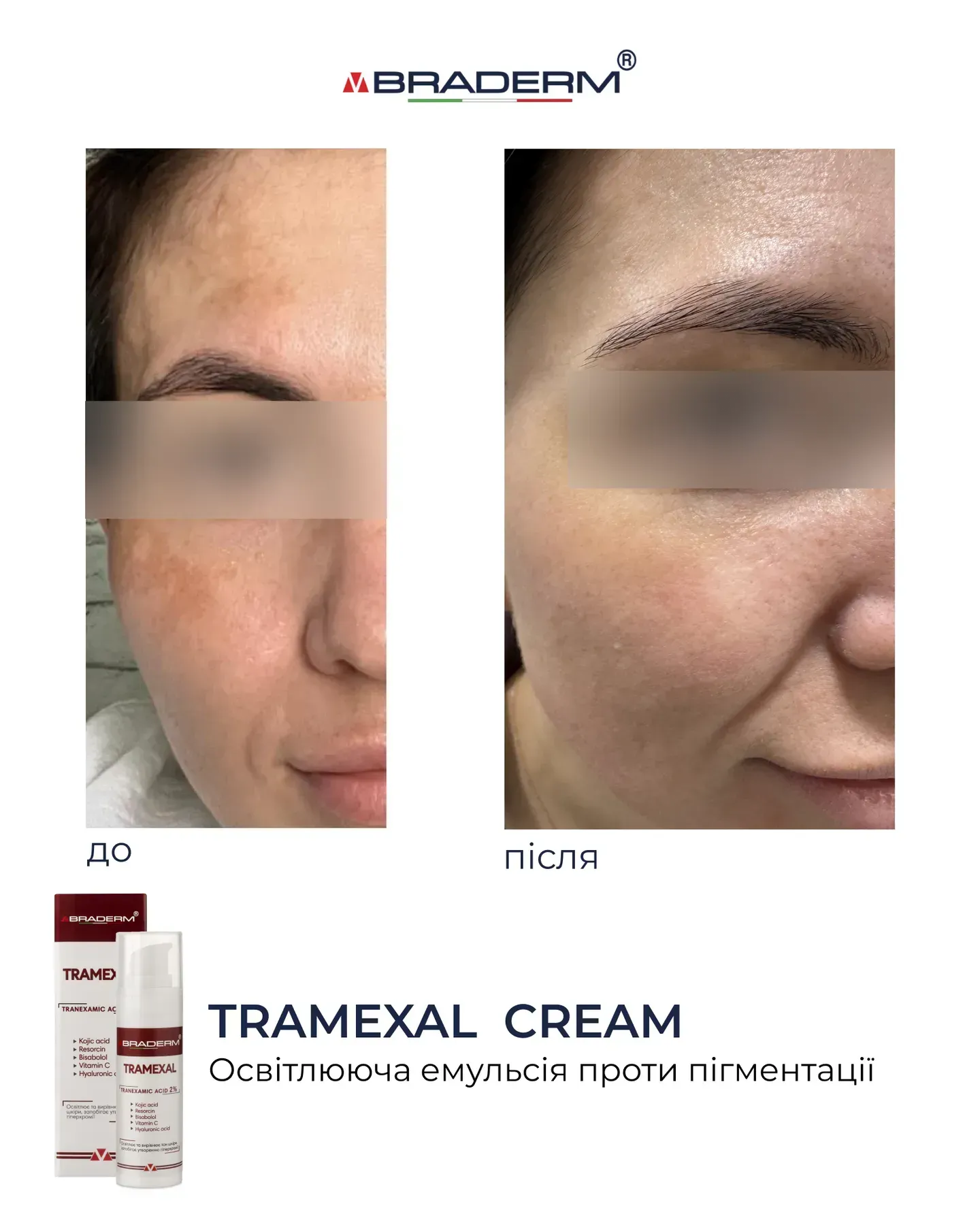 22 - Освітлюючий крем проти пігментації Braderm Tramexal Cream 30мл